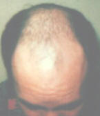 hair loss treatment, before